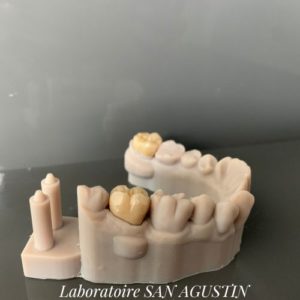 couronne full zircone monocouche