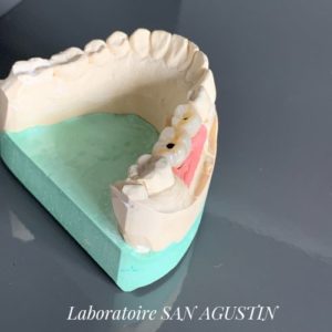 implants transvissés full zircone