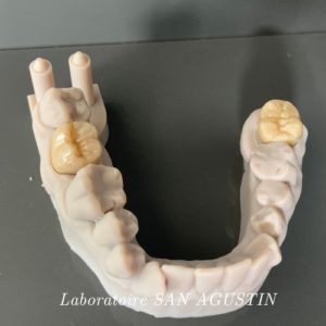 couronnes full zircone monocouche